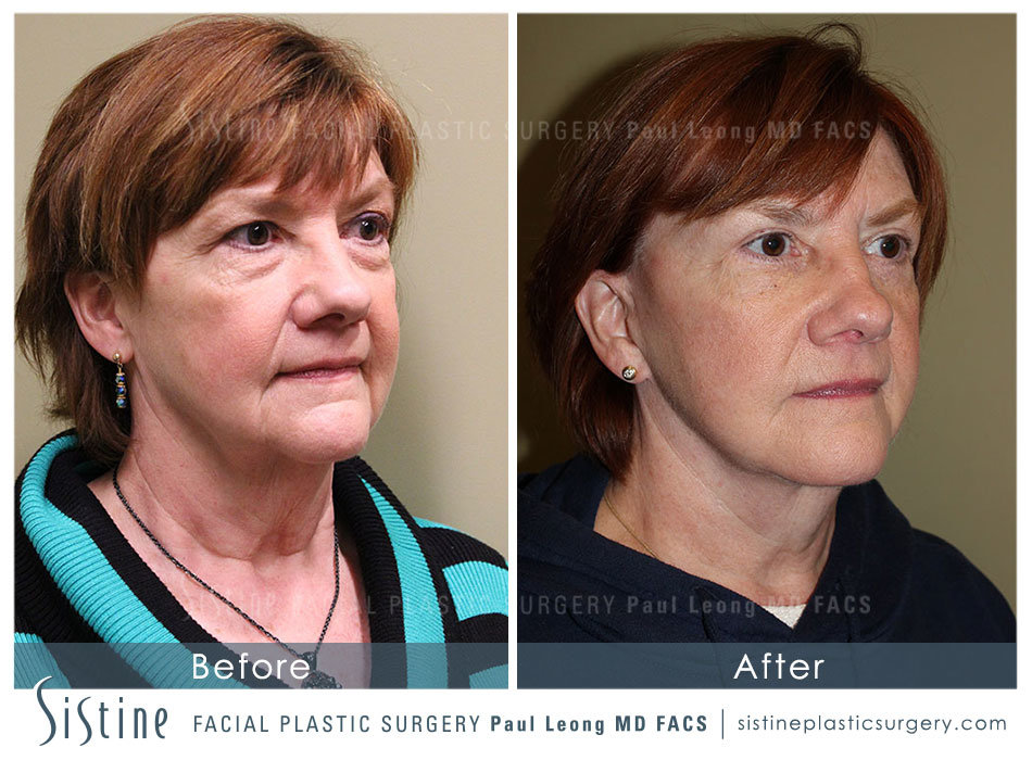 Face and Neck Lift Pittsburgh PA - Left Oblique Preoperative View | Sistine Facial Plastic Surgery