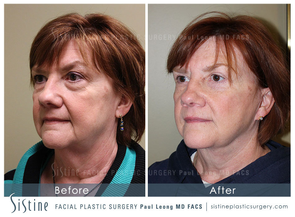 Highland Park Pittsburgh Face and Neck Lift  - Preoperative Right Oblique View - Sistine Facial Plastic Surgery