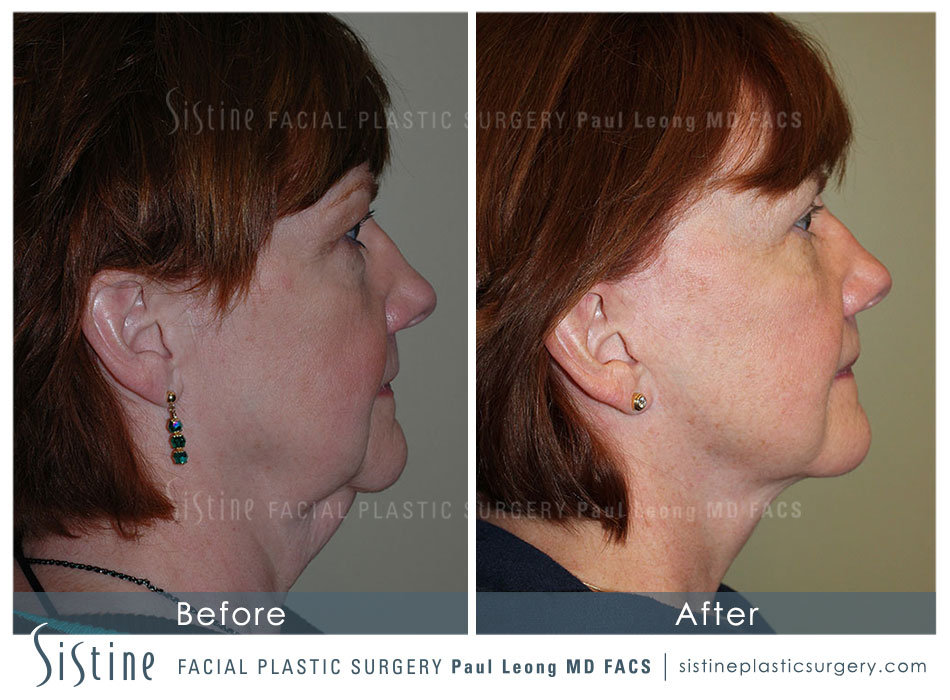 Sewickley Face and Neck Lift | Left Later Preoperative View | Sistine Facial Plastic Surgery