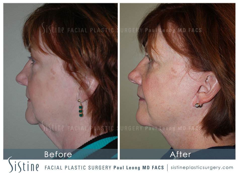 Wexford Face and Neck Lift | Preoperative Right Later View | Sistine Facial Plastic Surgery 