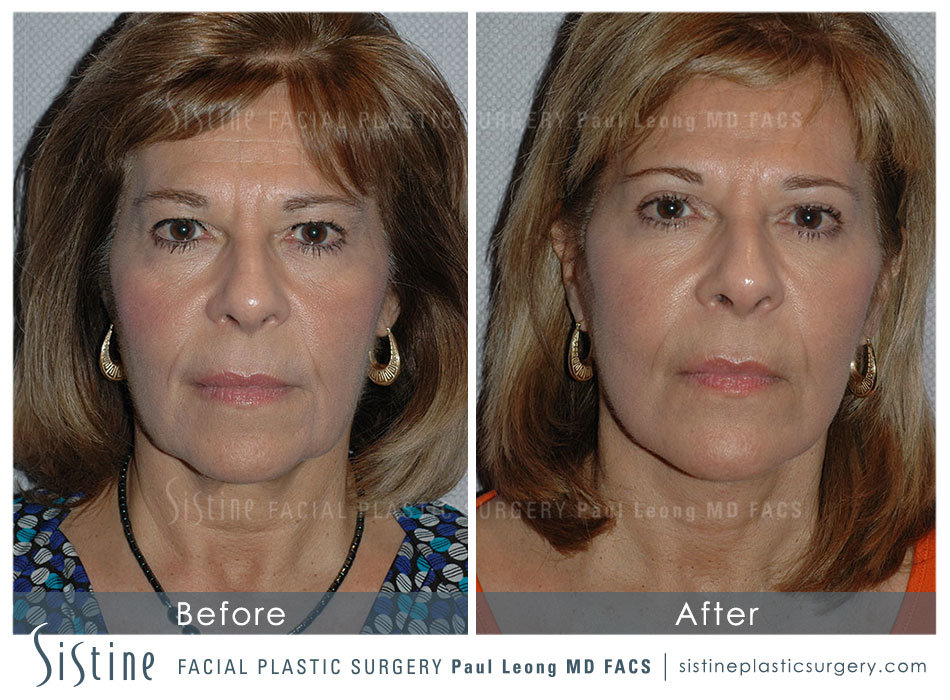 Facelift and Necklift Pittsburgh - Preoperative Frontal View | Dr. Paul Leong