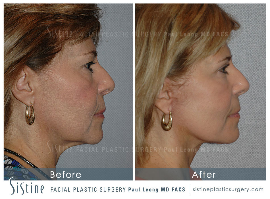 Facelift Necklift Wexford PA - Preoperative Left Lateral View | Dr. Paul Leong
