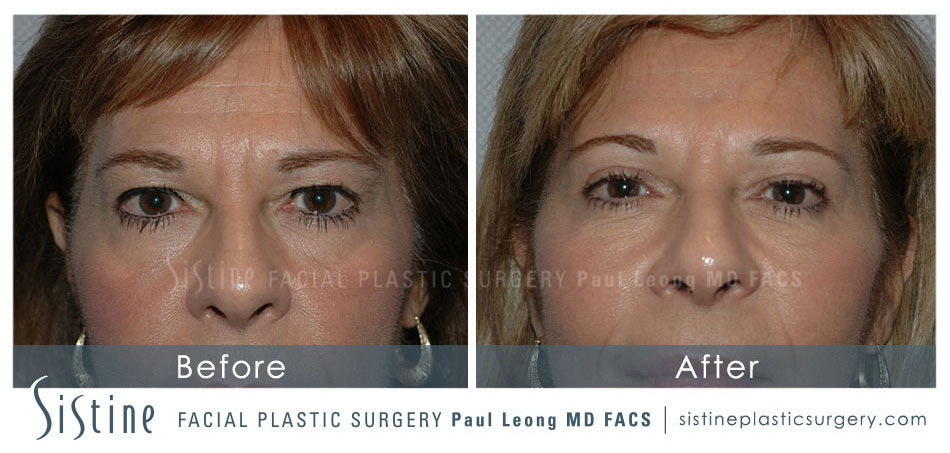 Blepharoplasty Pittsburgh - Preoperative Close-Up Frontal View | Dr. Paul Leong