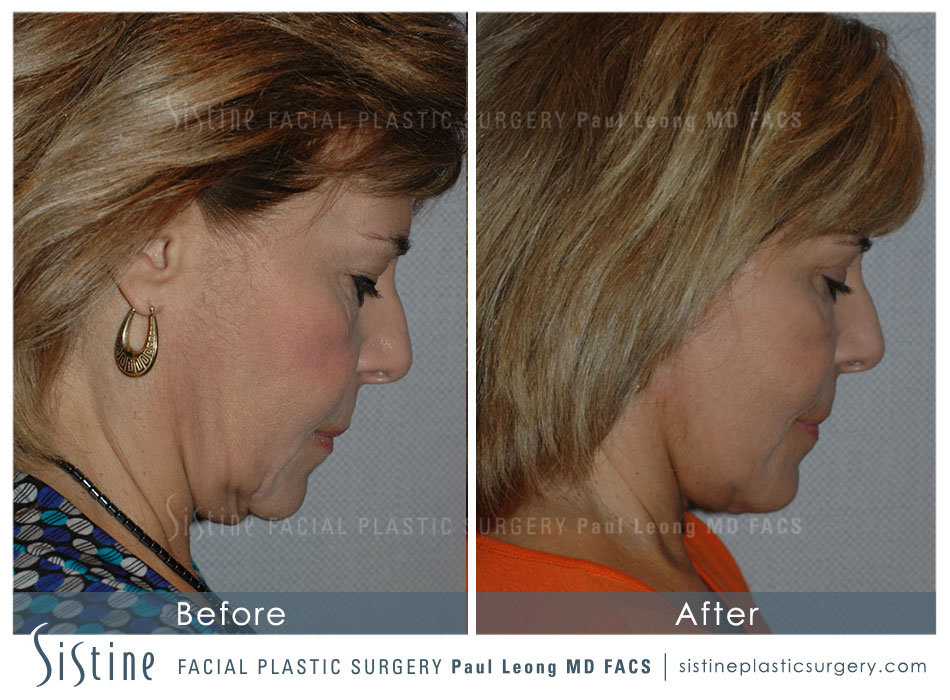 Pittsburgh Necklift - Preoperative View | Dr. Paul Leong 