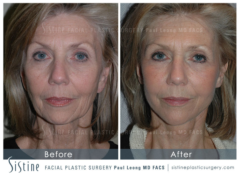 SMAS Facelift Pittsburgh - Preoperative Frontal View | Dr. Paul Leong