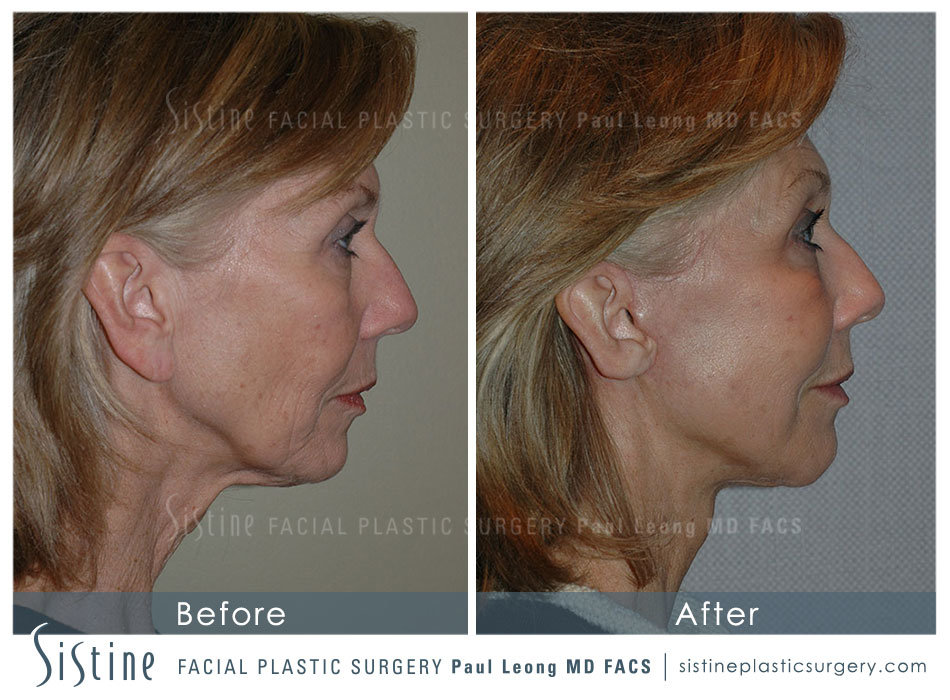 Plastic Surgery Pittsburgh - Preoperative Left Lateral View 