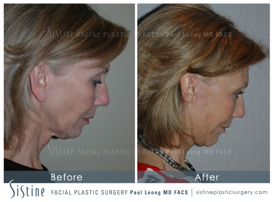 Plastic Surgery Photos - Preoperative Left Chin Tucked View | Dr. Paul Leong