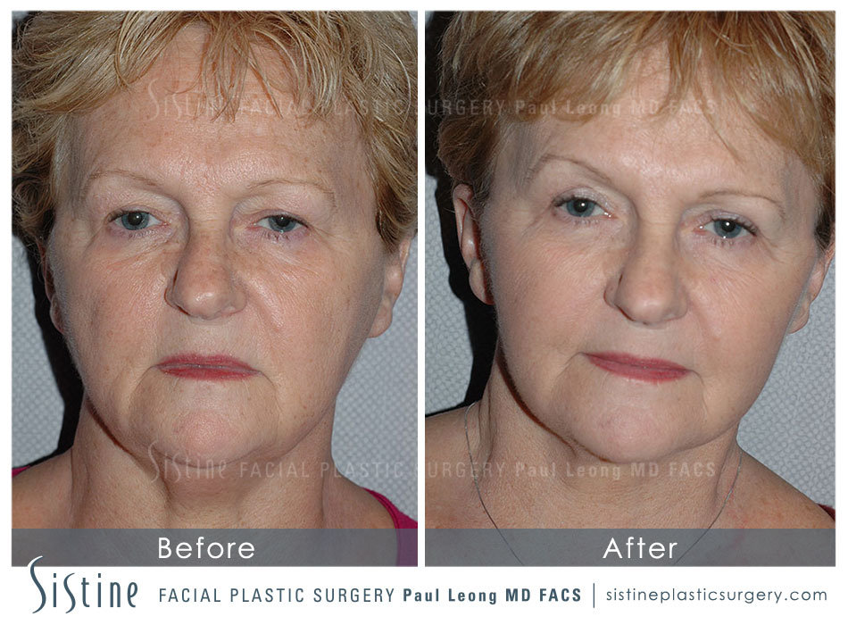 Sub SMAS Facelift Pittsburgh - Preoperative Frontal View | Dr. Paul Leong