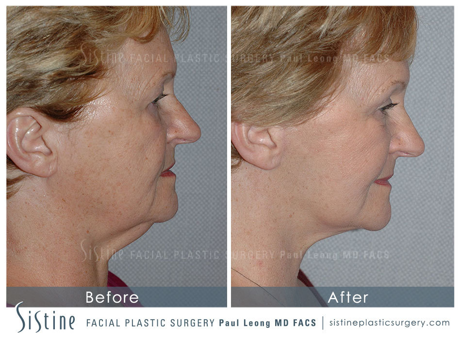 Sub-SMAS Facelift in Pittsburgh - Left Lateral Preoperative View | Dr. Paul Leong