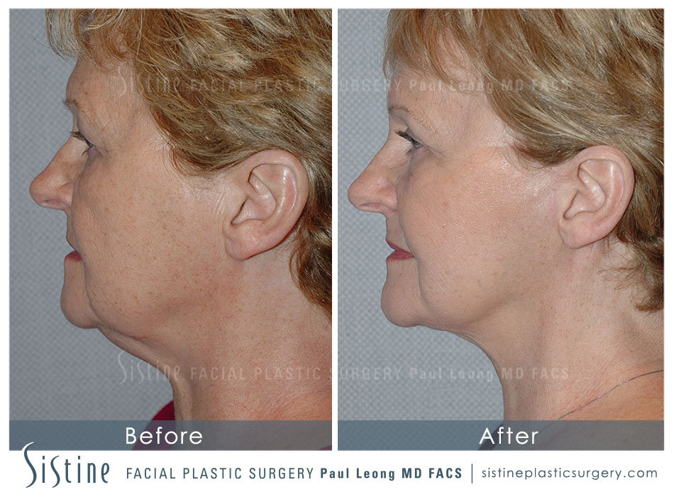 Sub SMAS Face Lift Pittsburgh - Right Lateral Preoperative View | Dr. Paul Leong