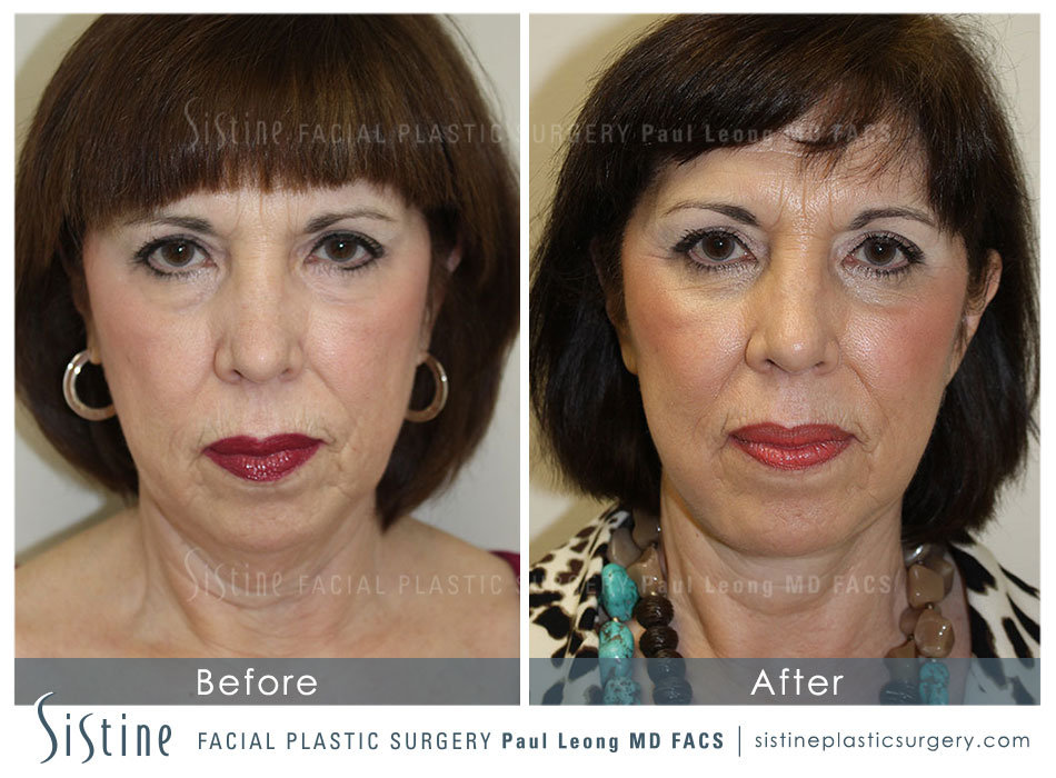 Face and Neck Lift Pittsburgh - Preoperative Frontal View | Dr. Paul Leong