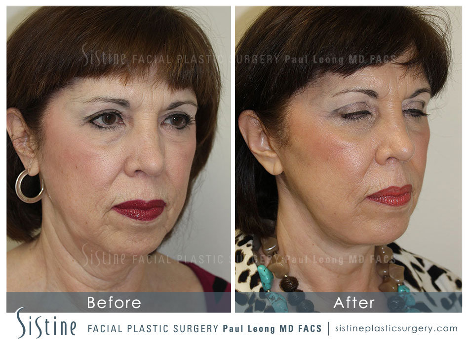 Pittsburgh Face and Neck Lift - Preoperative Left Oblique View | Dr. Paul Leong