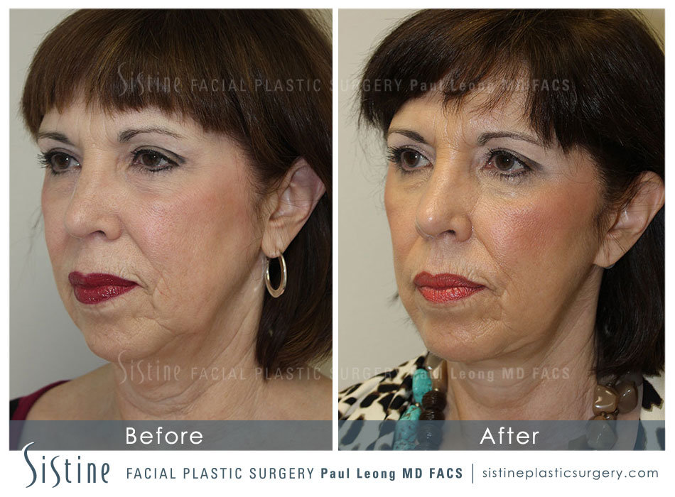 Face and Neck Lift in Pittsburgh - Preoperative Right Oblique View | Dr. Paul Leong