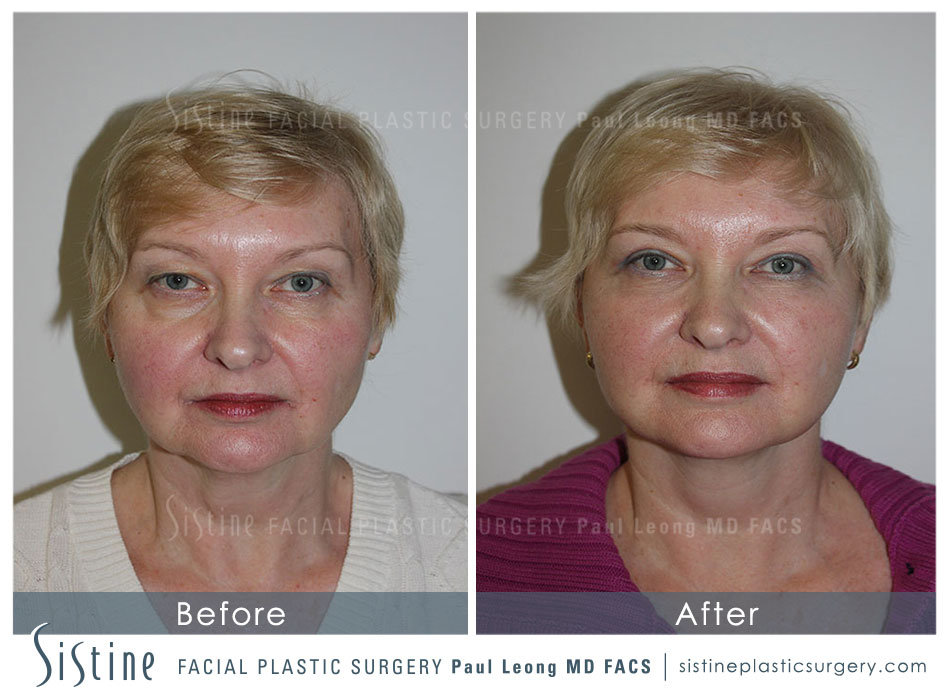 Pittsburgh Deep Plane Facelift - Preoperative View | Dr. Paul Leong
