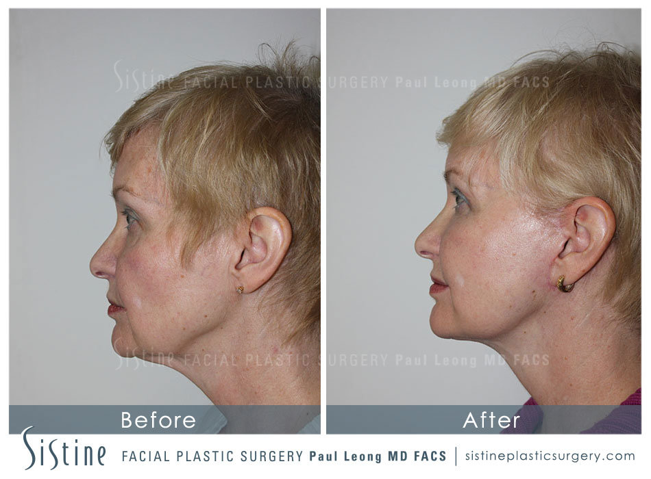 Deep Plane Facelift Before and After 50 Year Old - Presurgery | Paul Leong MD