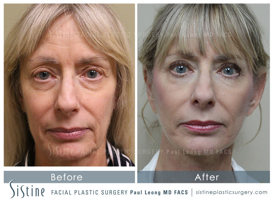Facelift Surgeon Pittsburgh - Before Image | Sistine Facial Plastic Surgery