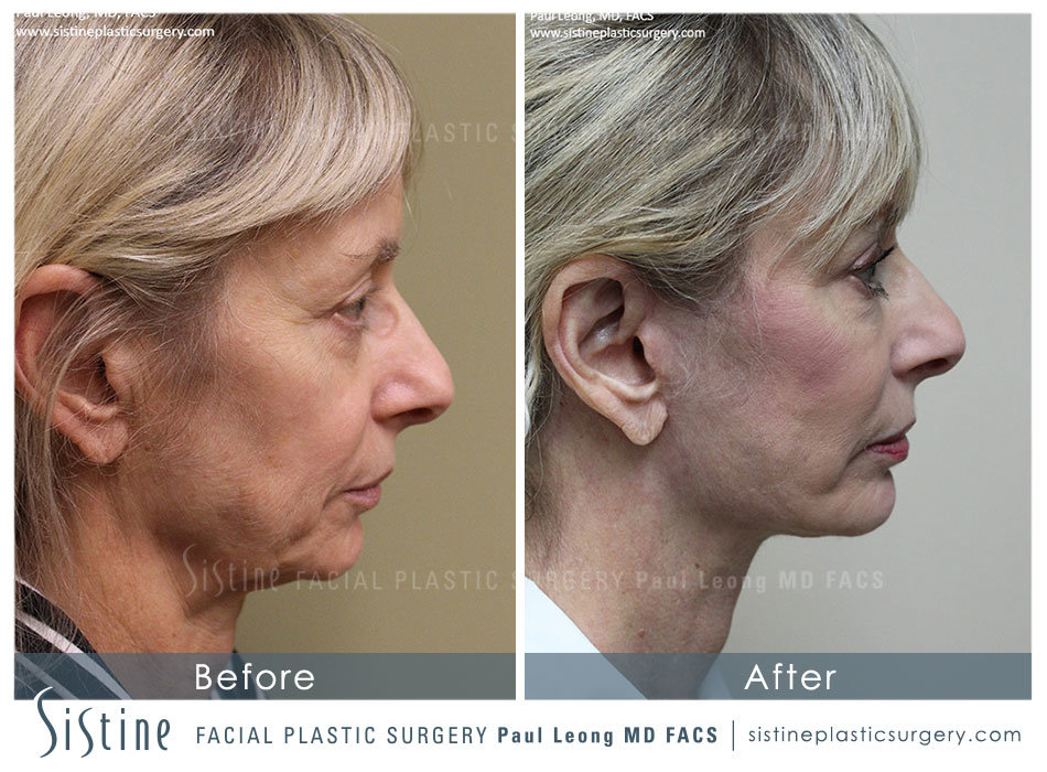 Facelift Sewickley - Before Image | Sistine Facial Plastic Surgery