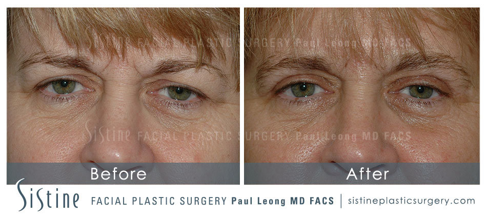 Blepharoplasty Procedure Pittsburgh PA - Frontal Preoperative View | Dr. Paul Leong