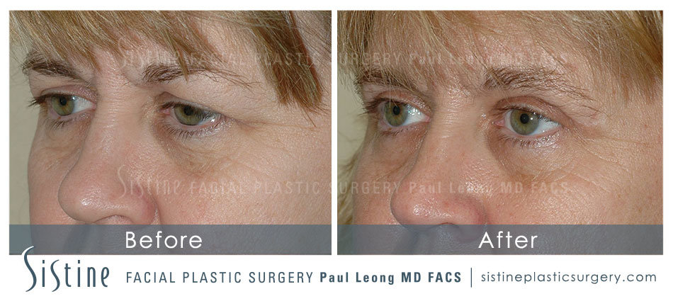 Pittsburgh PA Blepharoplasty Procedure - Preoperative Right Oblique View | Dr. Paul Leong