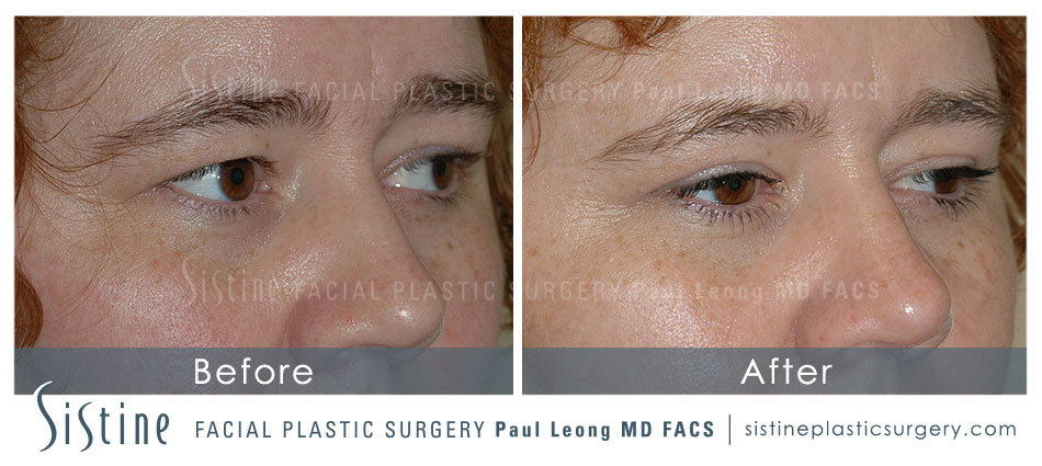 Eyes Before and After | Sistine Facial Plastic Surgery