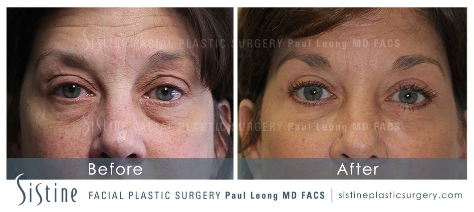 Upper Eyelid Blepharoplasty - Before Surgery | Sistine Facial Plastic Surgery