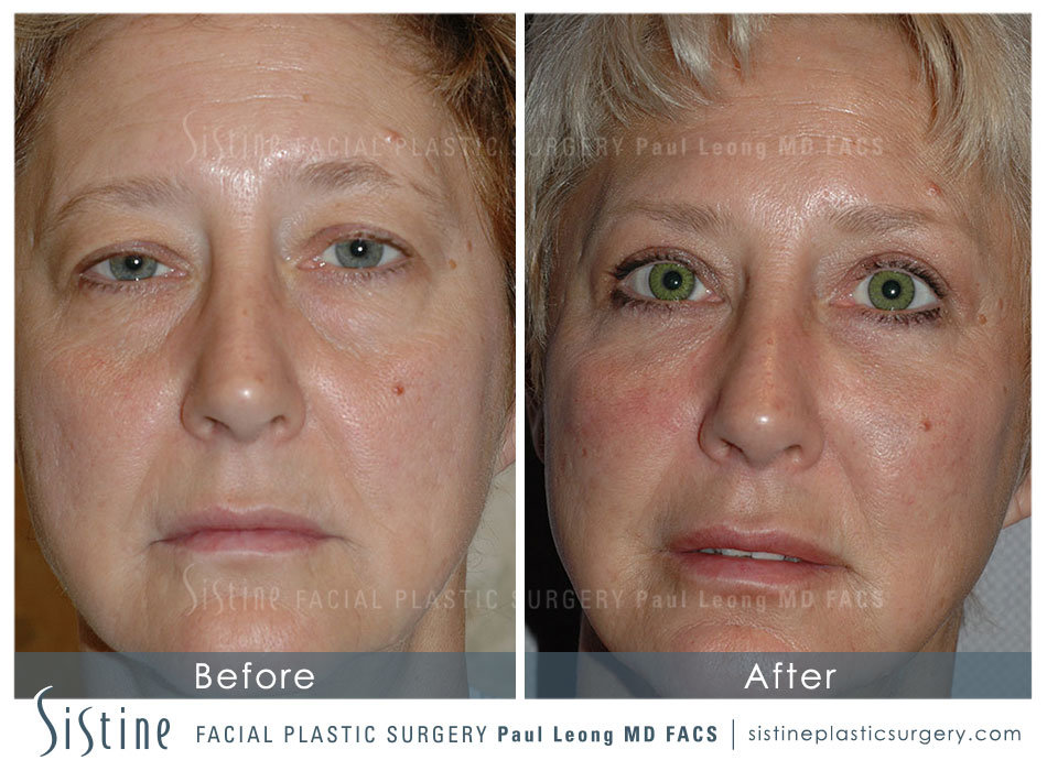 Pittsburgh PA Facial Fat Transfer - Frontal Preoperative View | Paul Leong MD