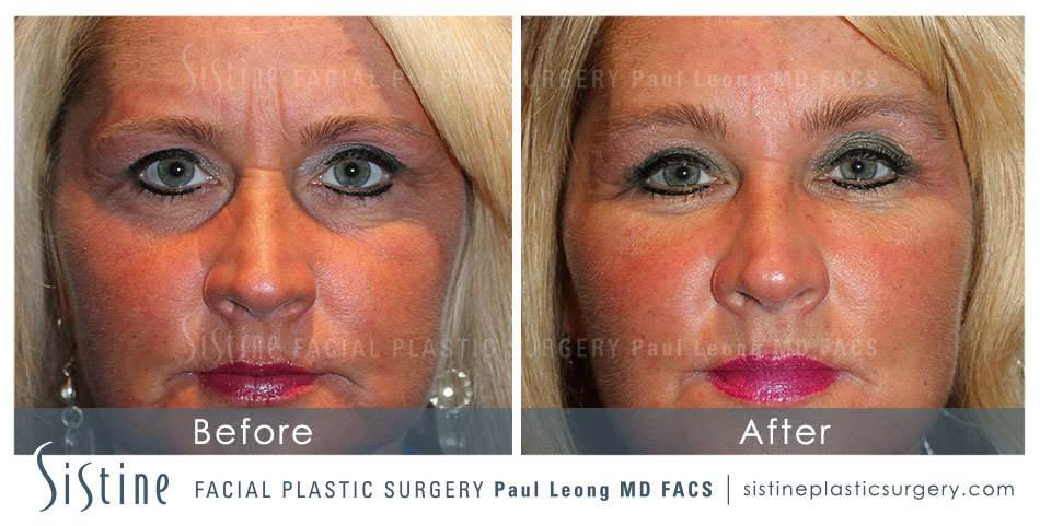 Perlane Filler - Frontal View (Before) | Sistine Facial Plastic Surgery, Pittsburgh PA