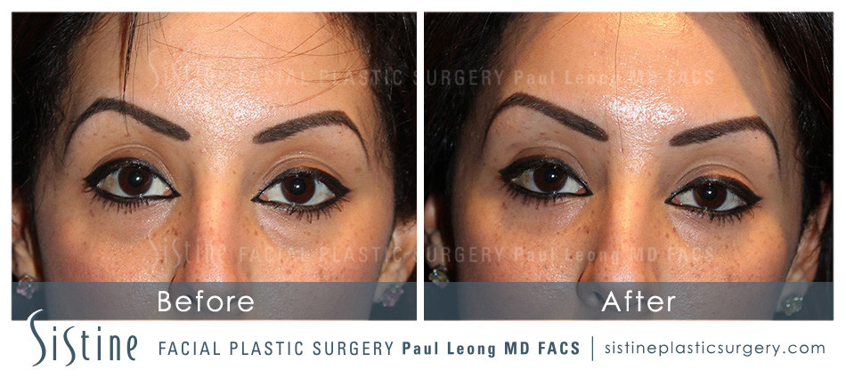 Restylane Dermal Filler Under-Eye Treatment - Before Image | Sistine Facial Plastic Surgery - Pittsburgh PA