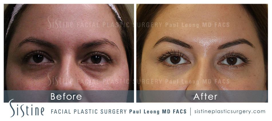 Restylane Tear Trough - Before Treatment | Dr. Paul Leong - Pittsburgh PA