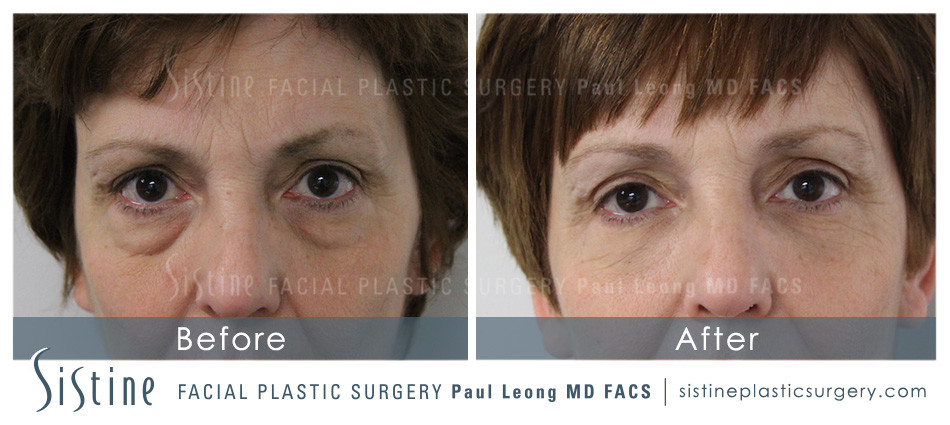 Tear Trough Treatment - Before Procedure | Dr. Paul Leong - Pittsburgh PA