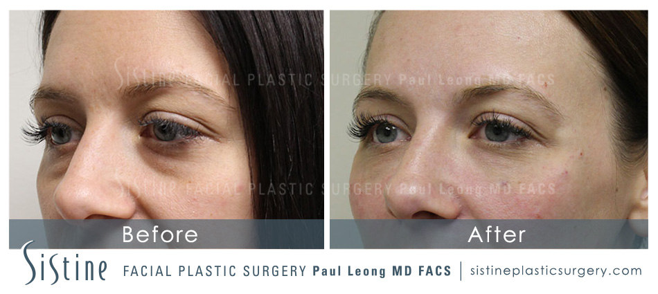 Tear Trough Filler in Pittsburgh PA - Before Image | Paul Leong MD - Sistine Facial Plastic Surgery