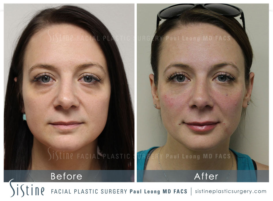 Pittsburgh PA Tear Trough Filler - Before Image | Dr. Paul Leong