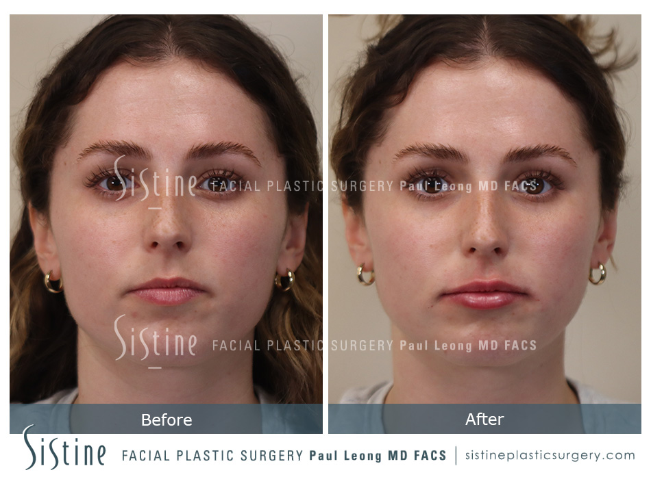 Lips Before and After | Sistine Facial Plastic Surgery