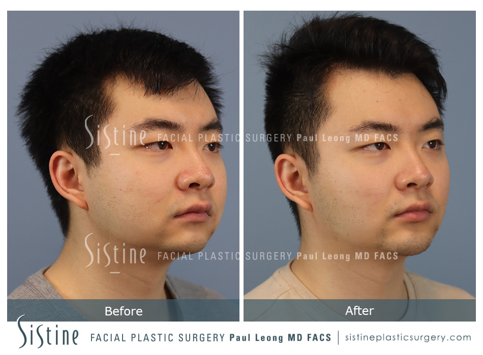 Masseter Before and After | Sistine Facial Plastic Surgery