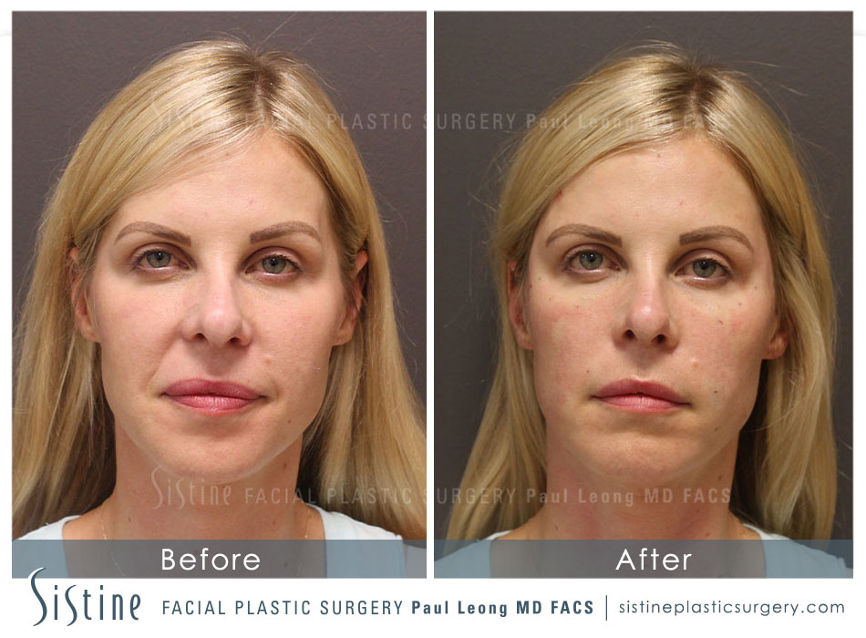 Nasolabial Folds Before and After 03 Sistine Facial