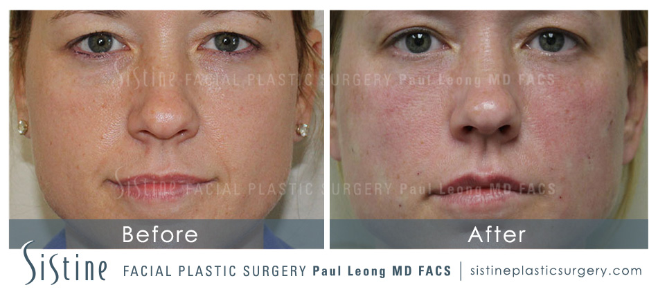 Nasolabial Folds Before and After | Sistine Facial Plastic Surgery