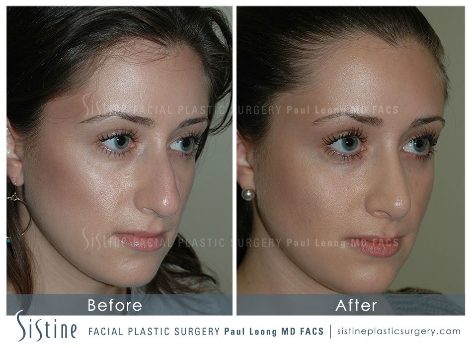 Nose Job Pittsburgh - Right Oblique Preoperative View | Dr. Paul Leong