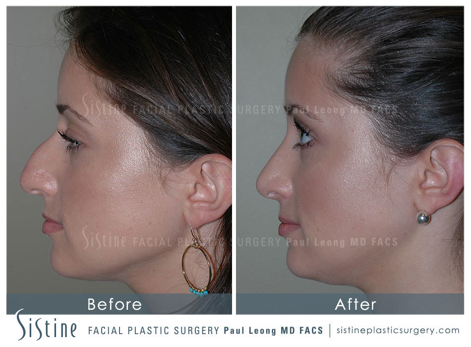Nose Jobs Near Me (Pittsburgh ) - Left Lateral Preoperative View | Sistine Facial Plastic Surgery