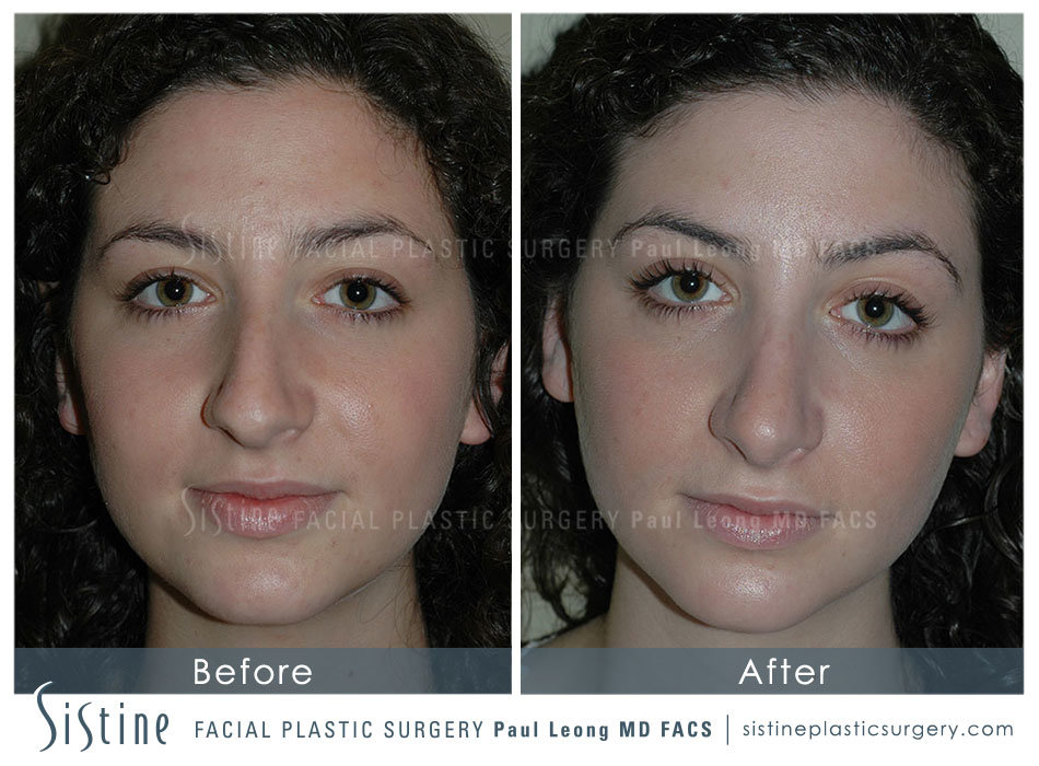 Nose Before and After 15 Sistine Facial Plastic Surgery