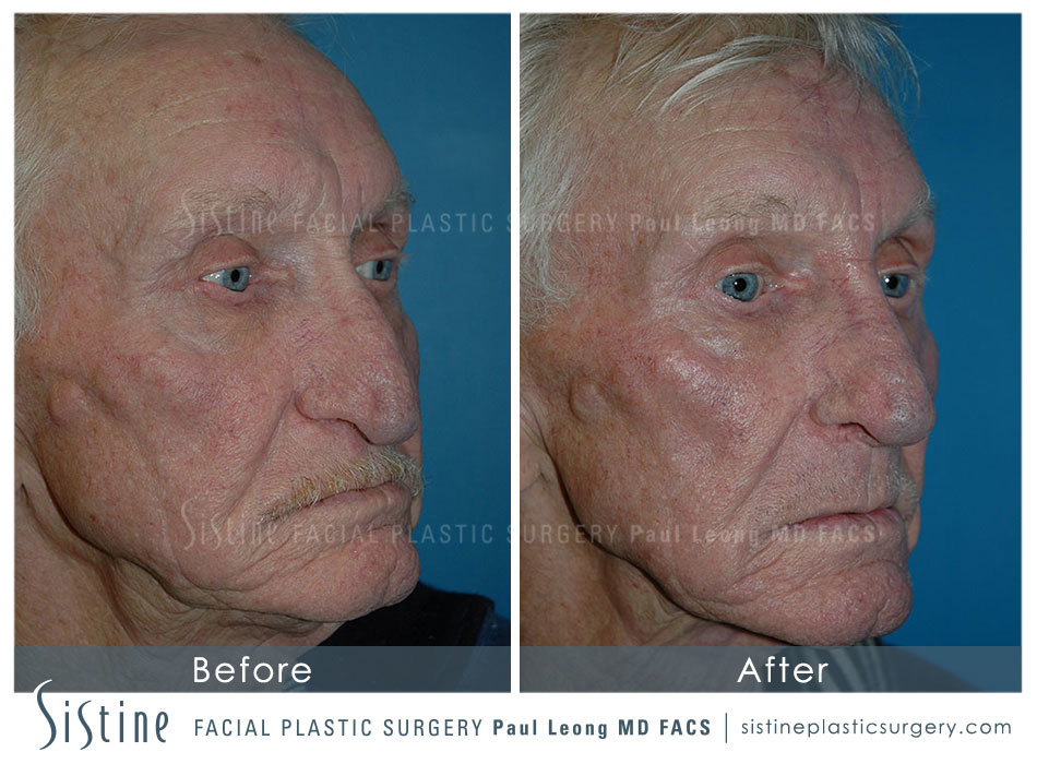 Nose Before and After | Sistine Facial Plastic Surgery