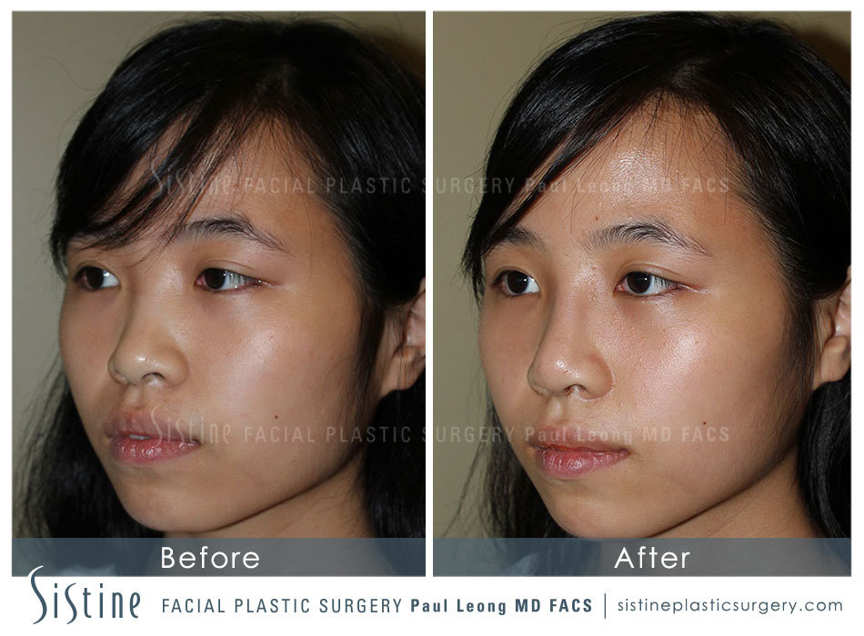 Nose Before and After 08 Sistine Facial Plastic Surgery