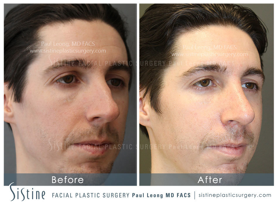 Pittsburgh Male Rhinoplasty - Patient Preoperative View | Dr. Paul Leong