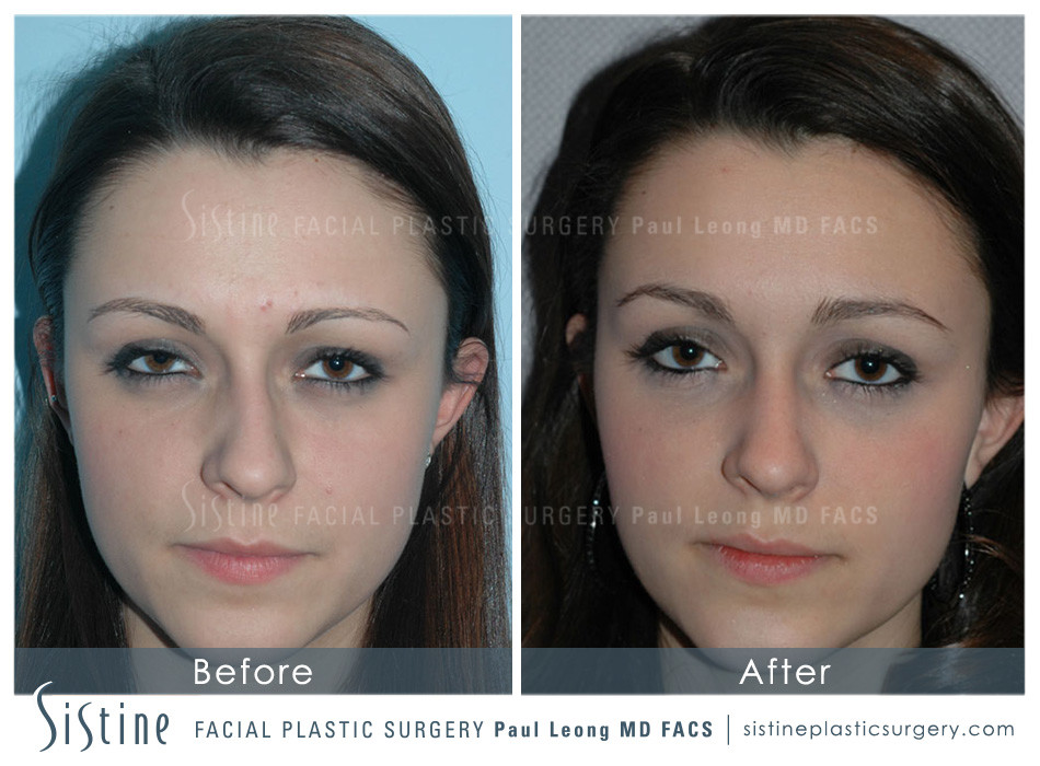 Pittsburgh PA Non-Surgical Rhinoplasty - Before Image | Dr. Paul Leong at Sistine Facial Plastic Surgery