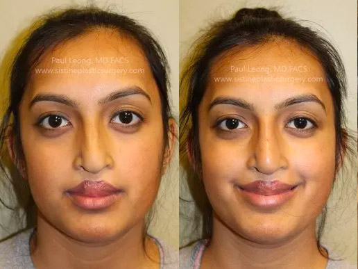 Non-Surgical Nose Job Near Me - After Image | Paul Leong MD Pittsburgh PA