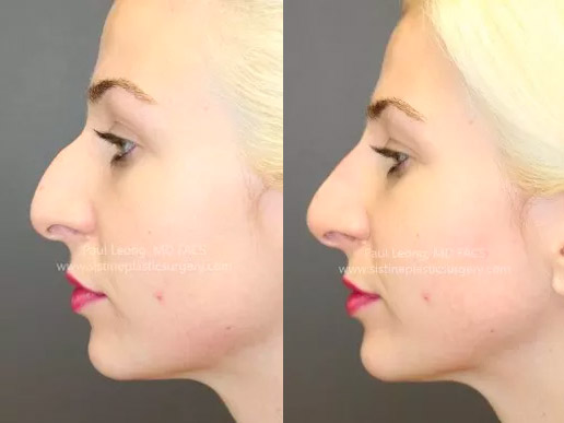Highland Park Pittsburgh Non-Surgical Rhinoplasty - Before | Dr. Paul Leong - Sistine Facial Plastic Surgery